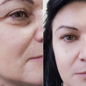 Eye Before and After | Cosmetic Facial Acupuncture | Acupuncture Therapeutics