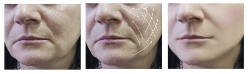 Patient | Jawls | Cosmetic Facial Acupuncture